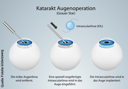 Katarakt - Augenoperation - Schematische Darstellung